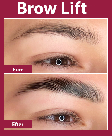 brow lift premium