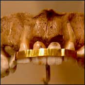 Etruscan women's teeth