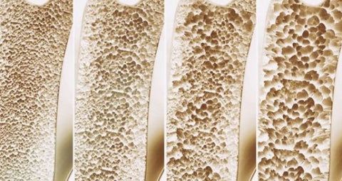 natural osteoporosis supplements