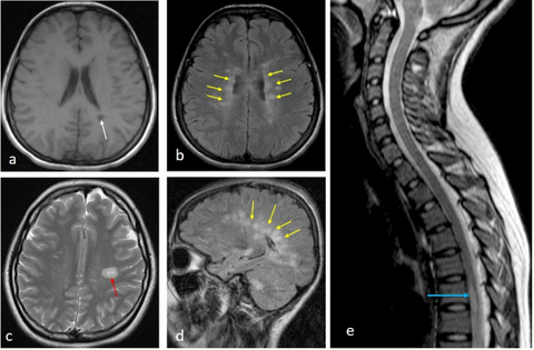 What is sclerosis?