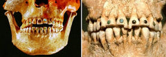 Ancient Civilizations - Gold Teeth with Gemstones