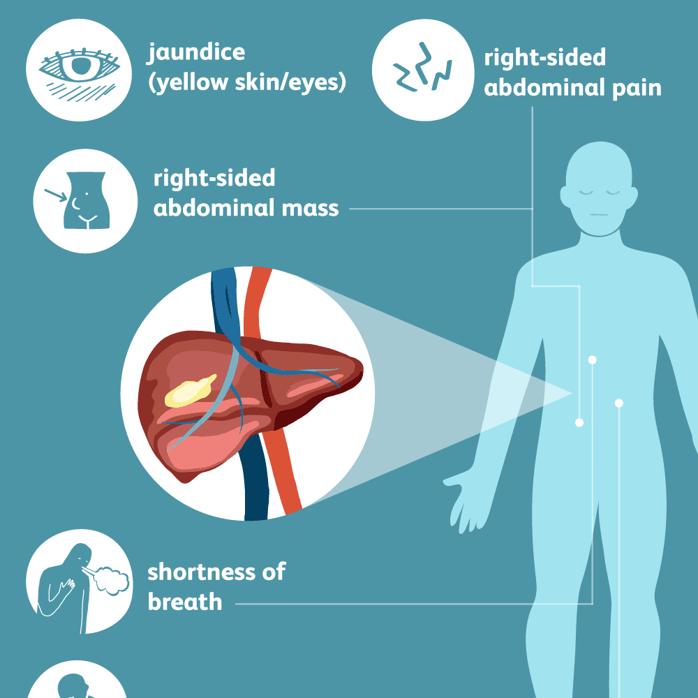 Liver Cancer Symptoms 5ae778bd1f4e1300366840a0 ?v=1592620454