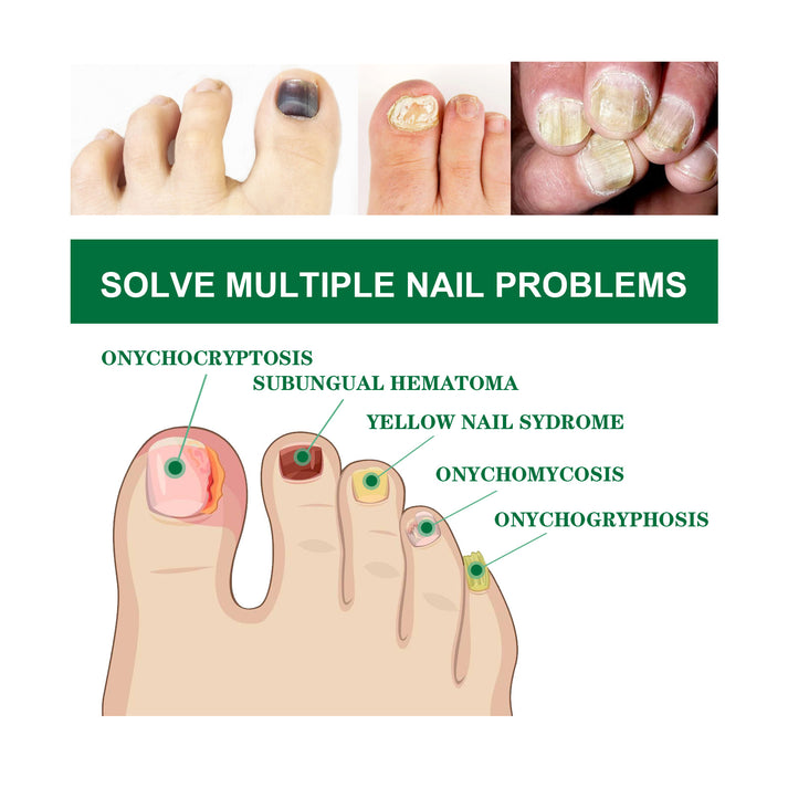 OUHOE Nail Fungal Treatment Serum Anti Infection Toe Fungus Repair Liq ...