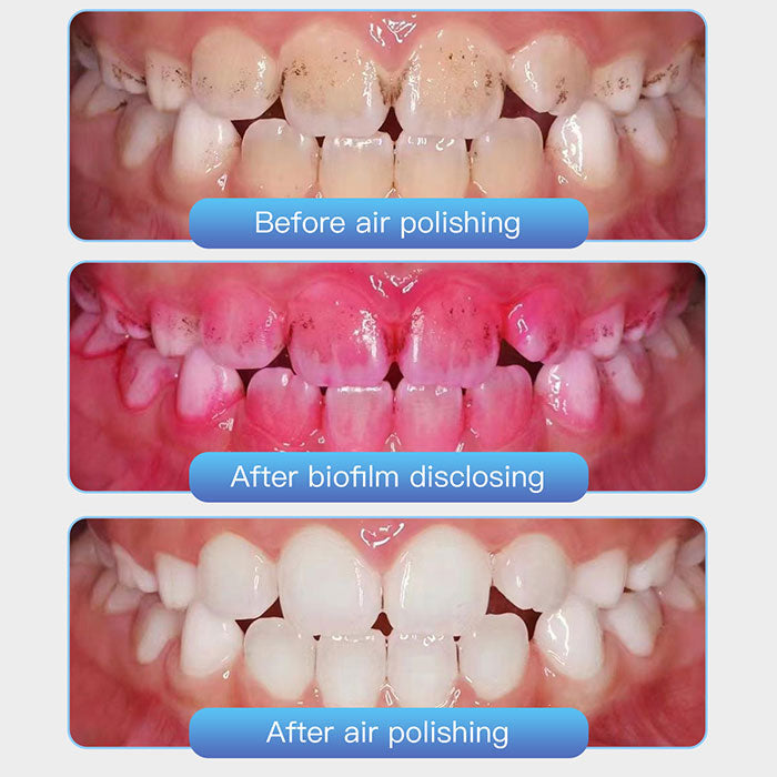 AZDENT Dental Air Polisher Prophy Teeth Whitening A1 Detachable 360° Rotating Handpiece 4 Holes - azdentall.com