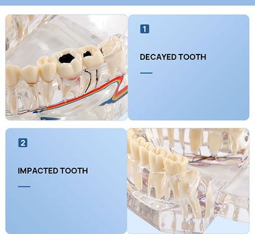 Dental Oral Typodont Model Implant Pathological Removable Teach Demo Transparent - azdentall.com