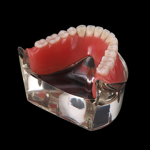 Dental Implant Teeth Model Demo Overdenture Restoration With 4 Implants Lower - azdentall.com