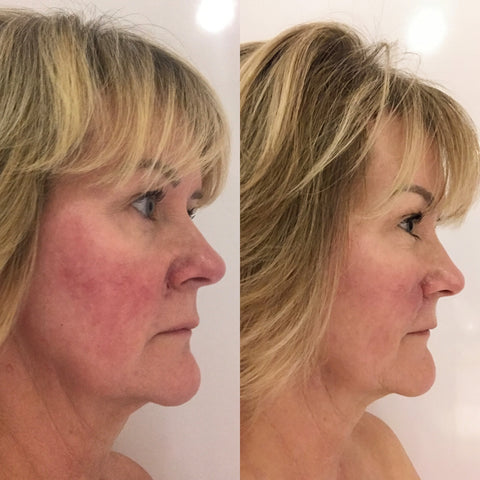 Rosacea Treatment. Rosacea Skincare. Rosacea Serum. Rosacea Cream. Rosacea.