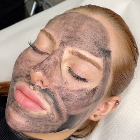 Laser Carbon Peel