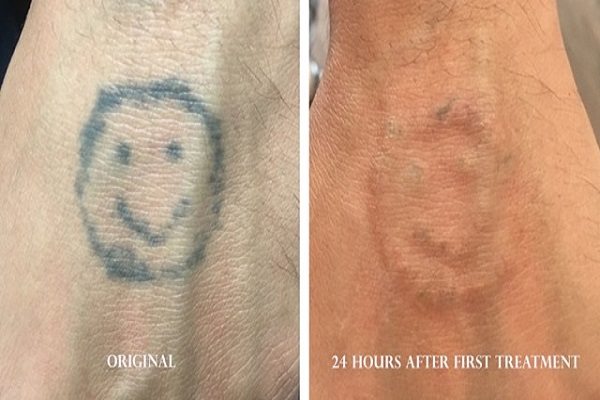 Tattoo Removal and Pigment Removal in Jupiter FL  Jupiter Dermatology   Hair Restoration