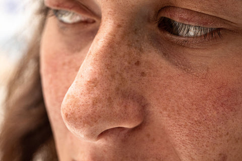 Best Facial Treatments For Sun Damaged Skin closeup portrait of a thirty year old girl with freckles and sun spots on the nose and cheeks