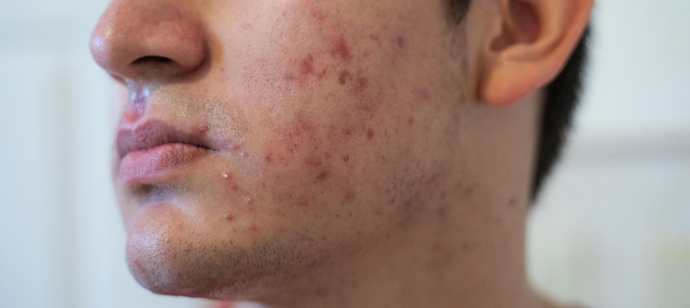 Acne skincare for men