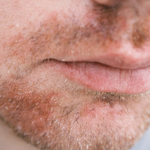 Perioral Dermatitis omkring munden