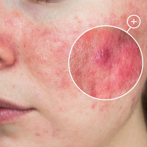 Rosacea betændt hud forårsaget af Demodex-mider