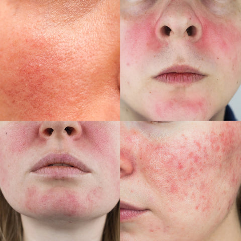 Different examples of rosacea