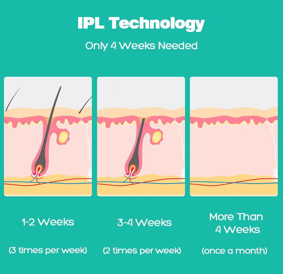 Does Ipl Hair Removal Work