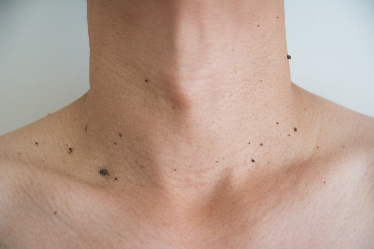 Mole Removal Before And After