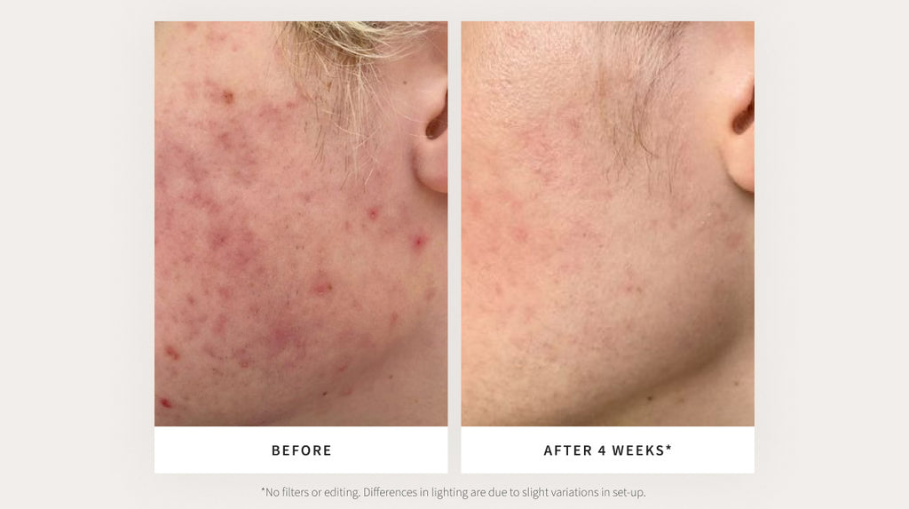 Before and After using probiotic skincare 