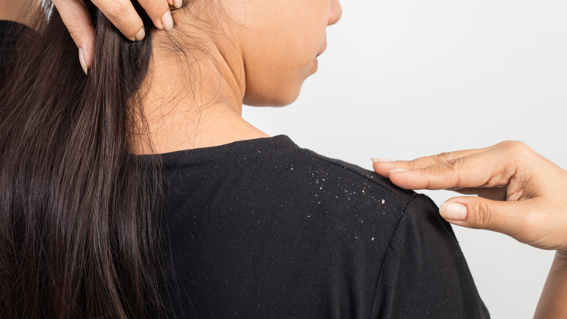 The Difference Between Dandruff and Product Build-Up - New York