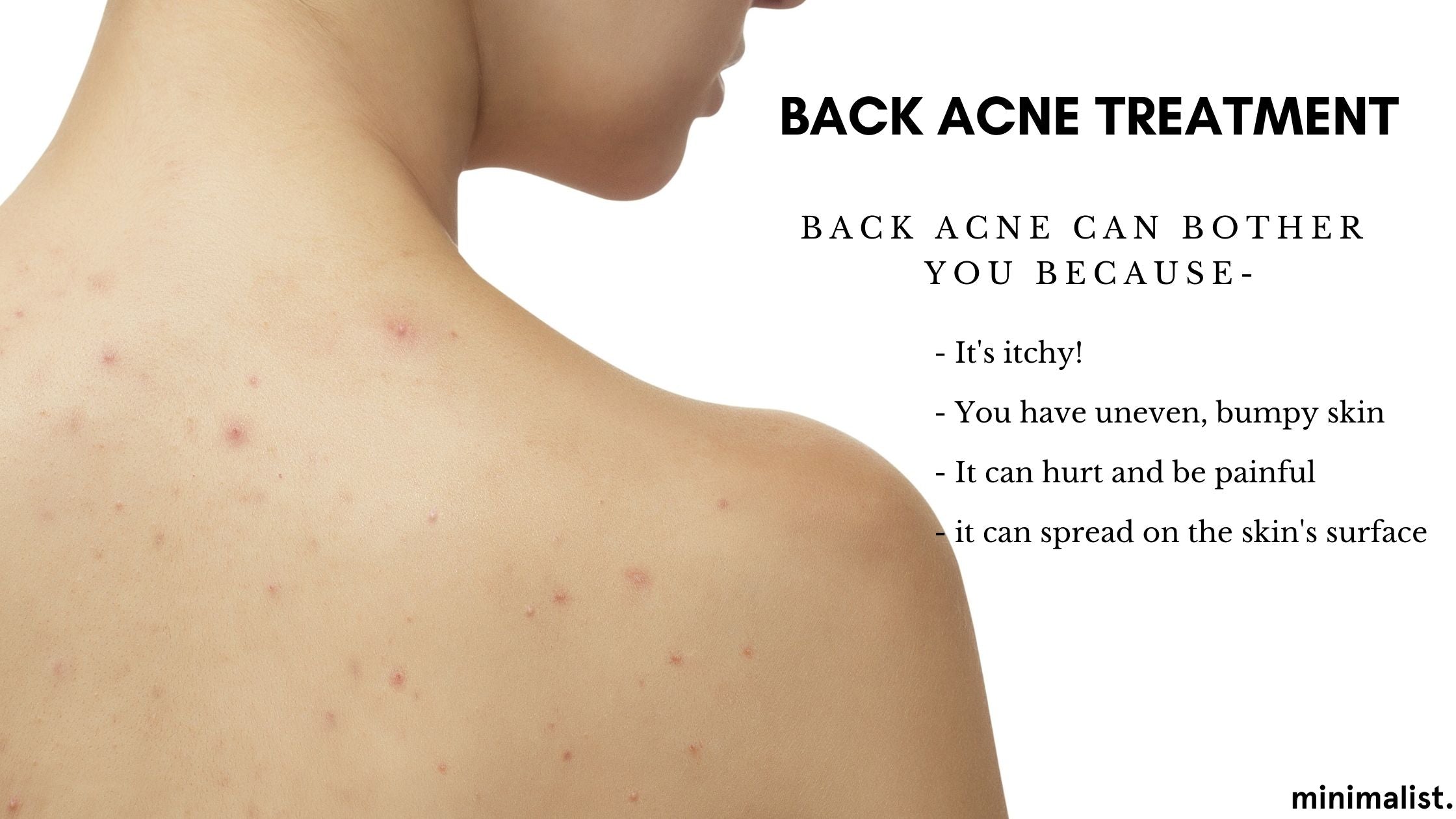 Back Acne: Causes, Treatment & Prevention – Minimalist