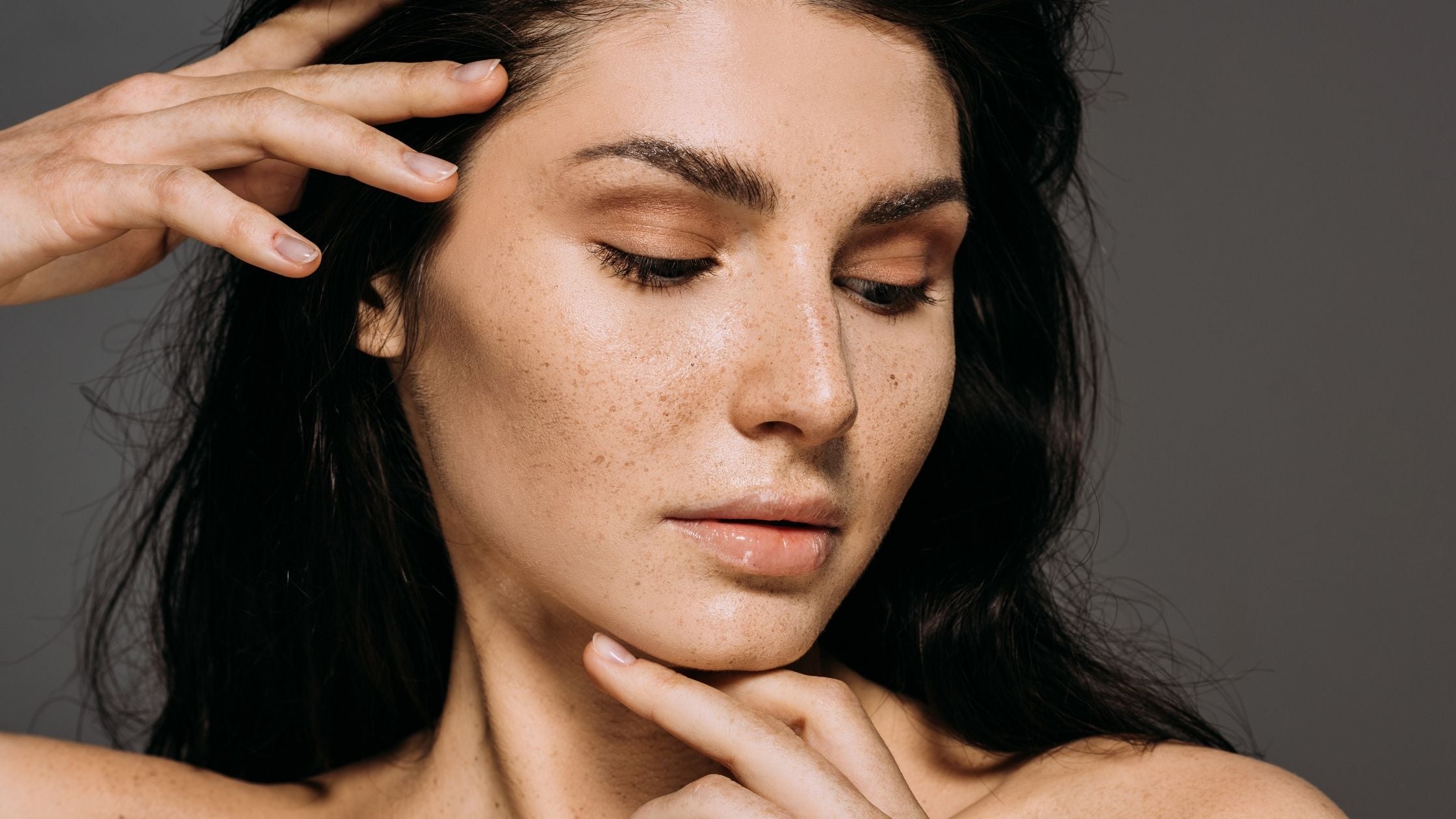 Freckles: What They Are, vs. Moles, Causes & Removal