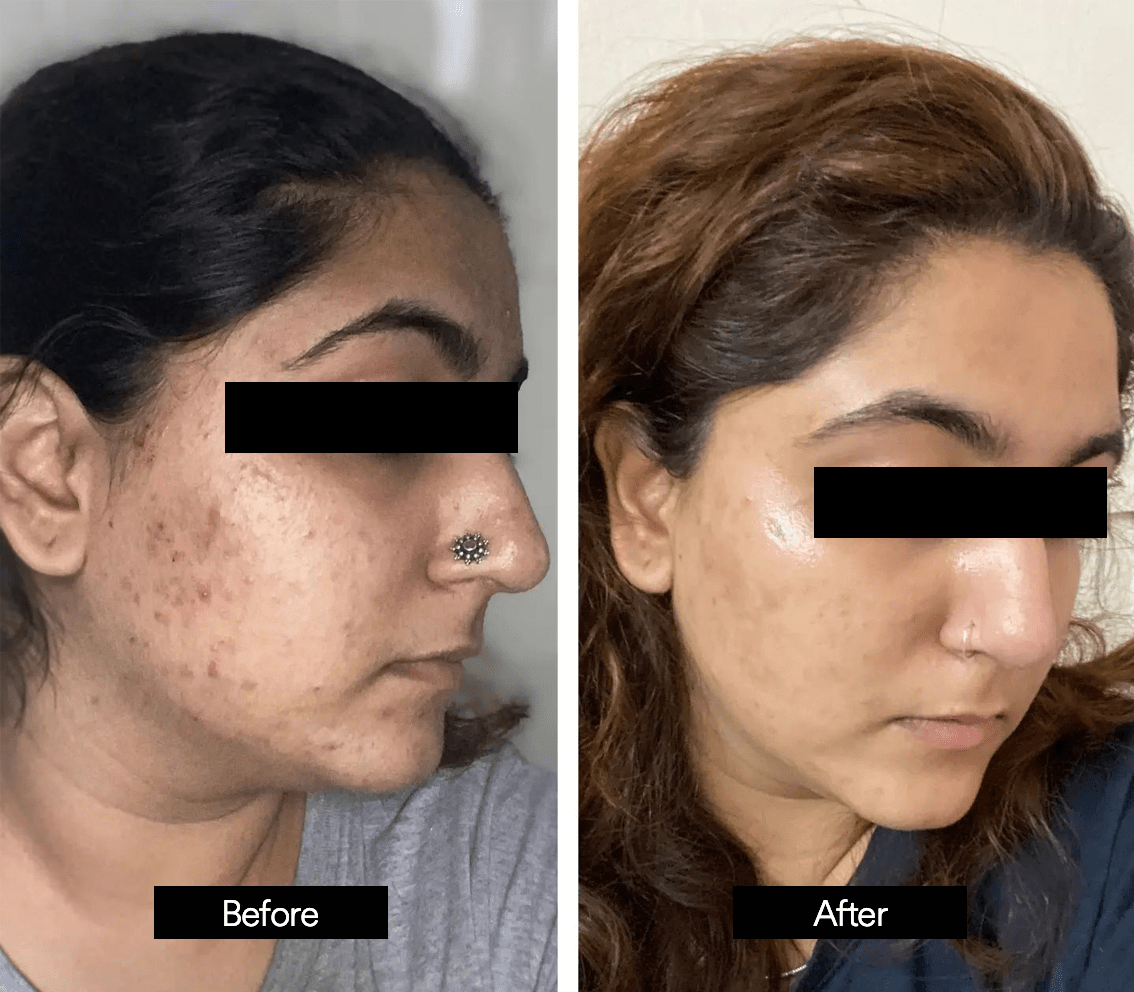 salicylic acid before and after