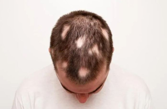 Alopecia areata