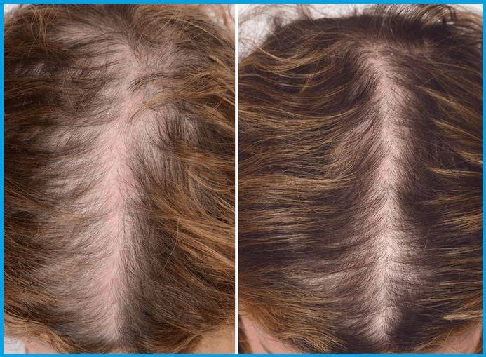 Androgenetic Alopecia Hair Thinning Disorder
