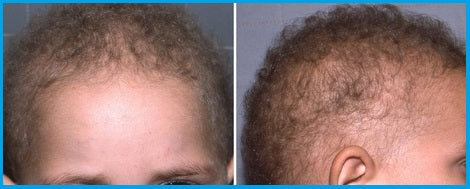 Congenital Hypotrichosis Hair Thinning Disorder