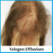 Telogen Effluvium Hair Thinning Disorder