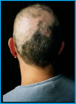Trichotillomania hair thinning disorder