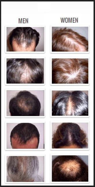 Types of hairloss