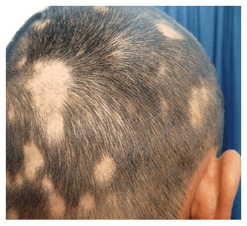 Alopecia on a man's scalp