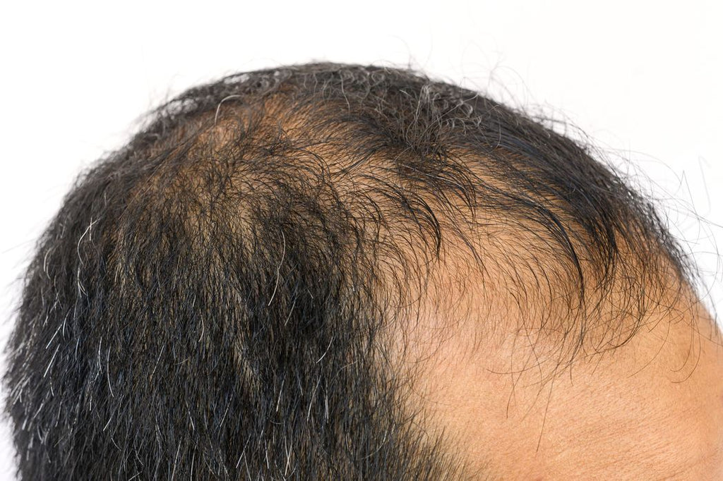 Male pattern baldness. Zoomed in image of a balding man's scalp and receding hairline.