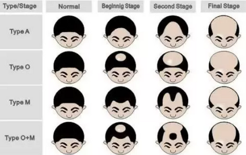 Male pattern baldness stages infographic