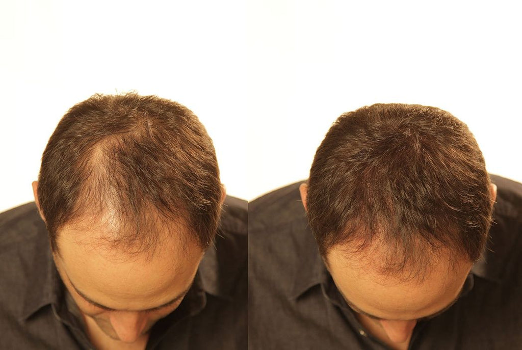 Before and after of a man using KeraFiber on scalp to conceal hair loss and receding hairline.