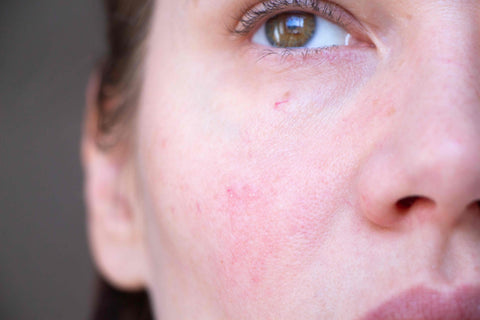 Sådan du rød og irriteret hud ansigtet | Bioeffect