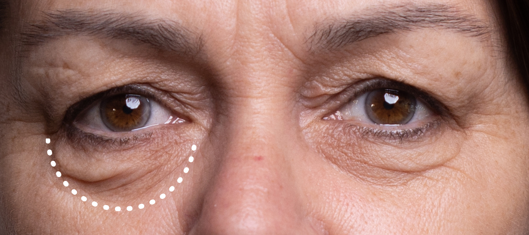 are-you-considering-eye-bag-removal-surgery-first-find-out-about-opt