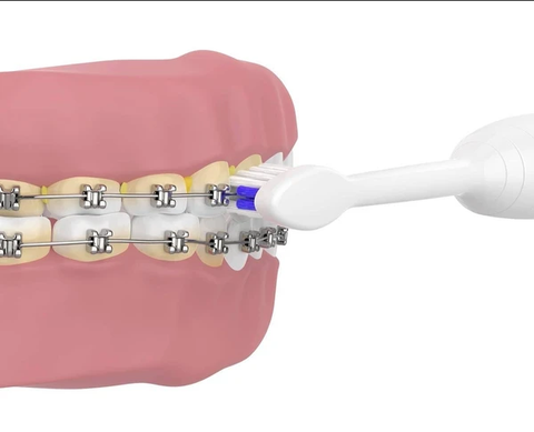 removing plaque from teeth with braces using an electronic toothbrush