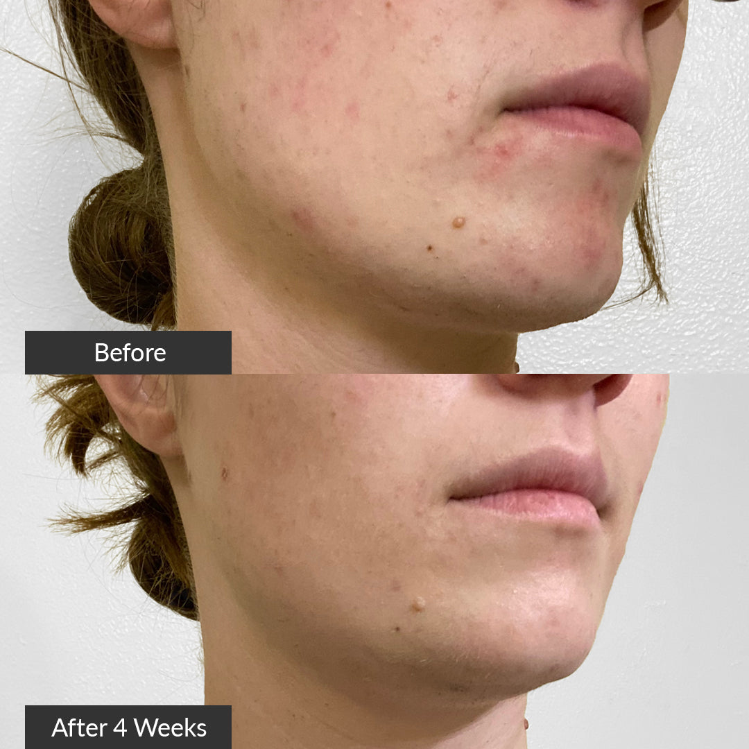 PMD Clean Acne