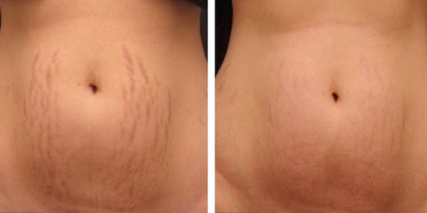 Stretch Marks Before & After Using Derma roller