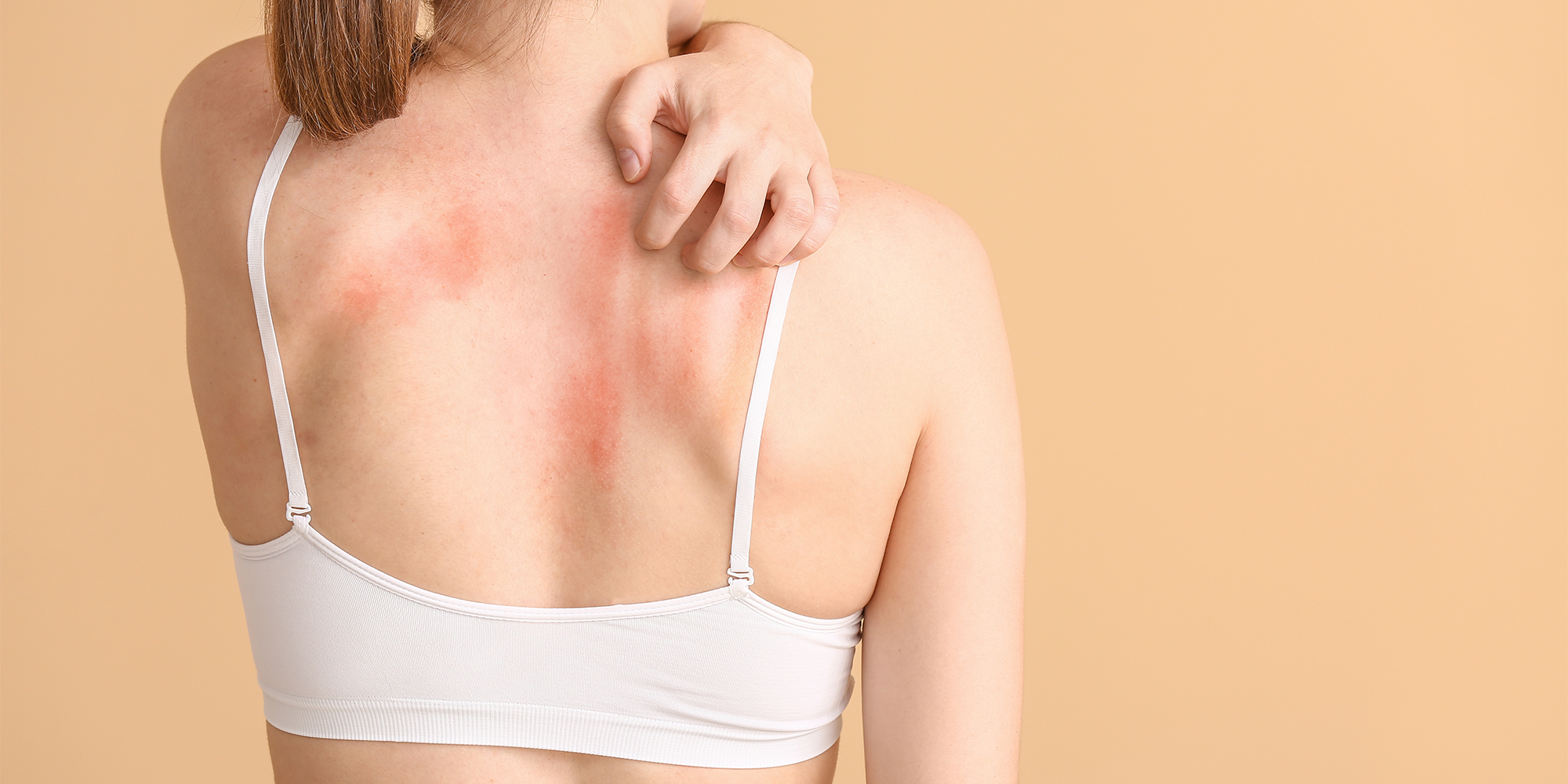 Infection de la peau, rougeurs dans le dos (zona, furoncle, abcès, mycoses...)