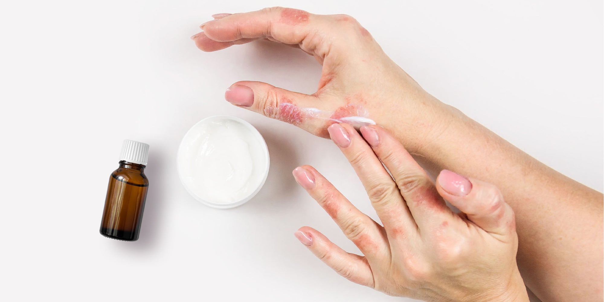 Crème neutre + huile essentielle pour traiter le psoriasis