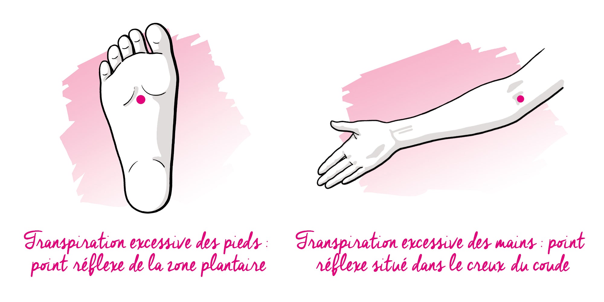 Points pour la transpiration excessive des mains et des pieds