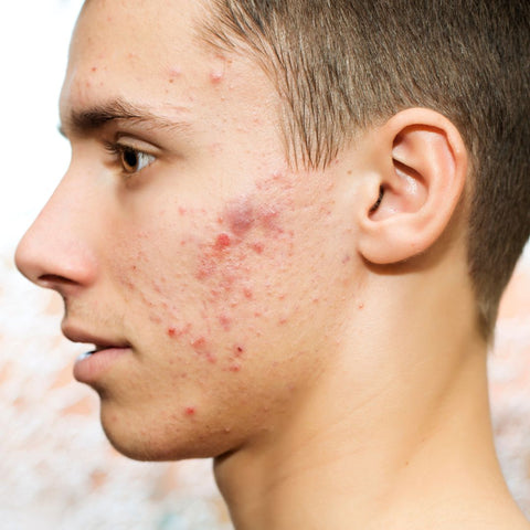 Acné folliculitis barbae men