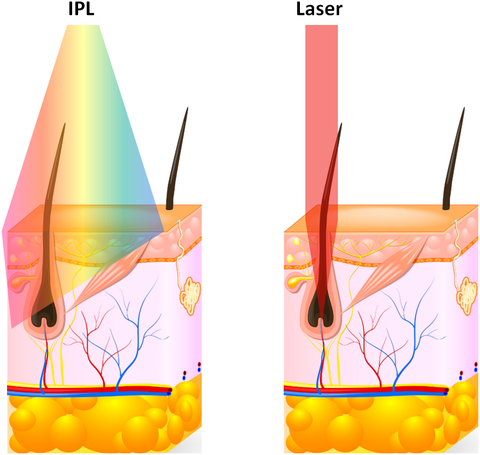 IPL verus laser hair removal