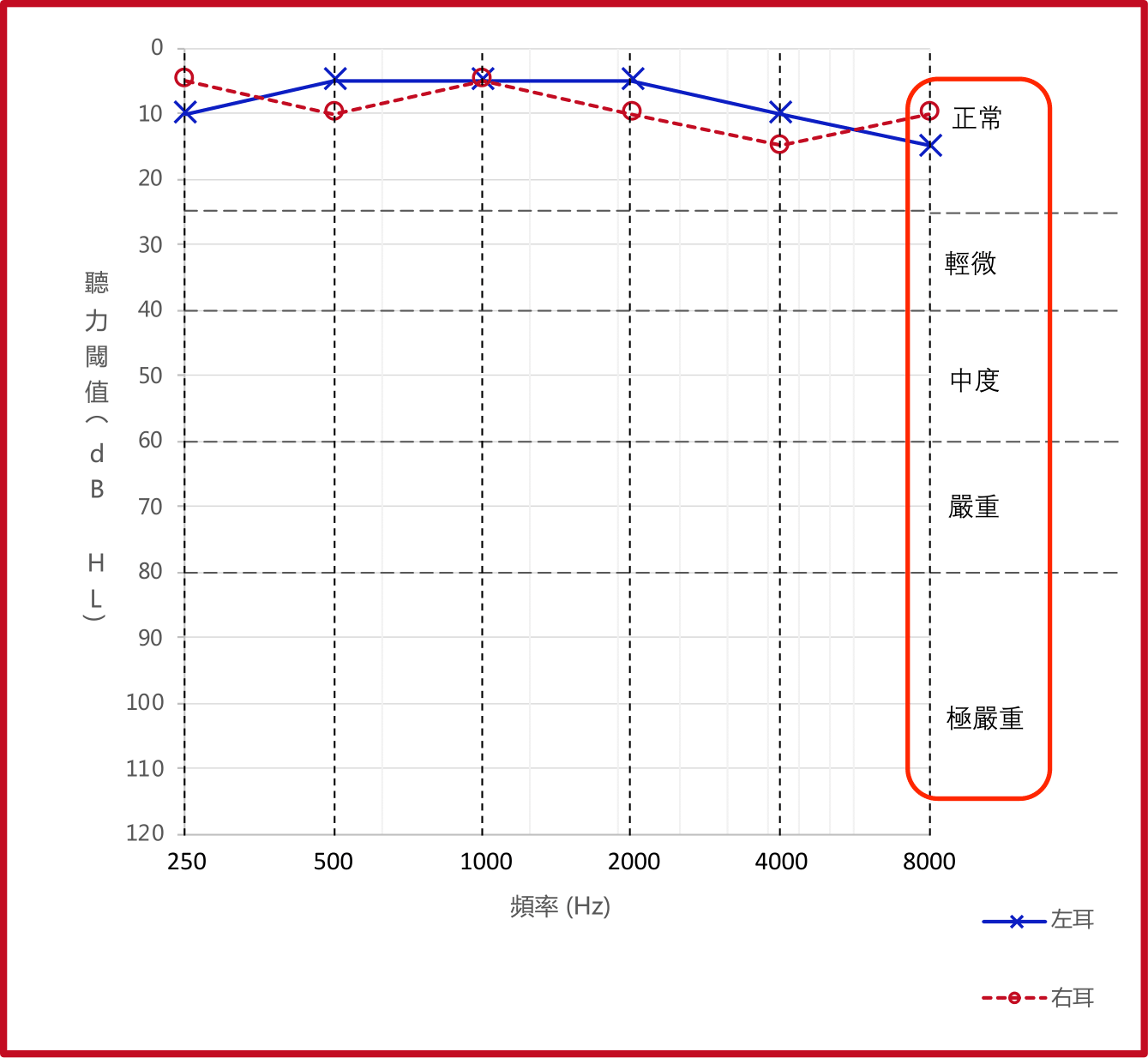 聽力圖裏顯示的四種程度的聽覺障礙