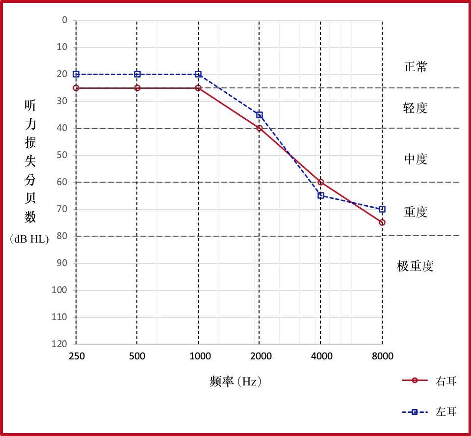 典型的与年龄有关的听力损失图