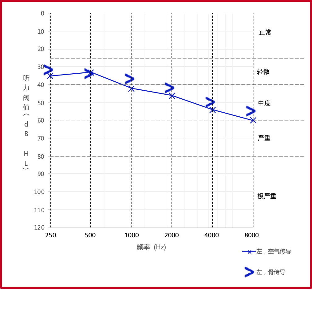 神经性听力损失听力图