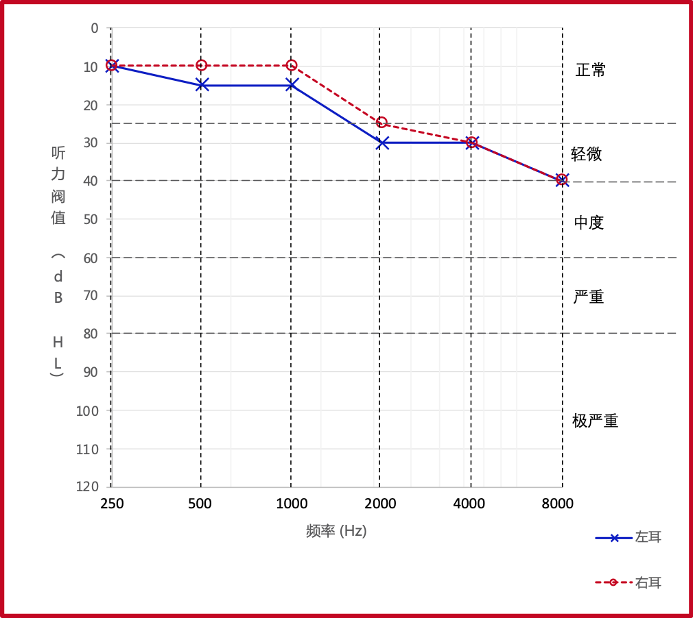 对称性听力损失听力图