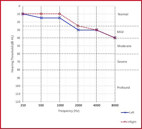 Symmetrical hearing loss audiogram